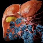 Medical visualization the liver with fat cells triggering the production of C-reactive protein, colored blue, highlighting how C-reactive protein is a key biomarker of inflammation.