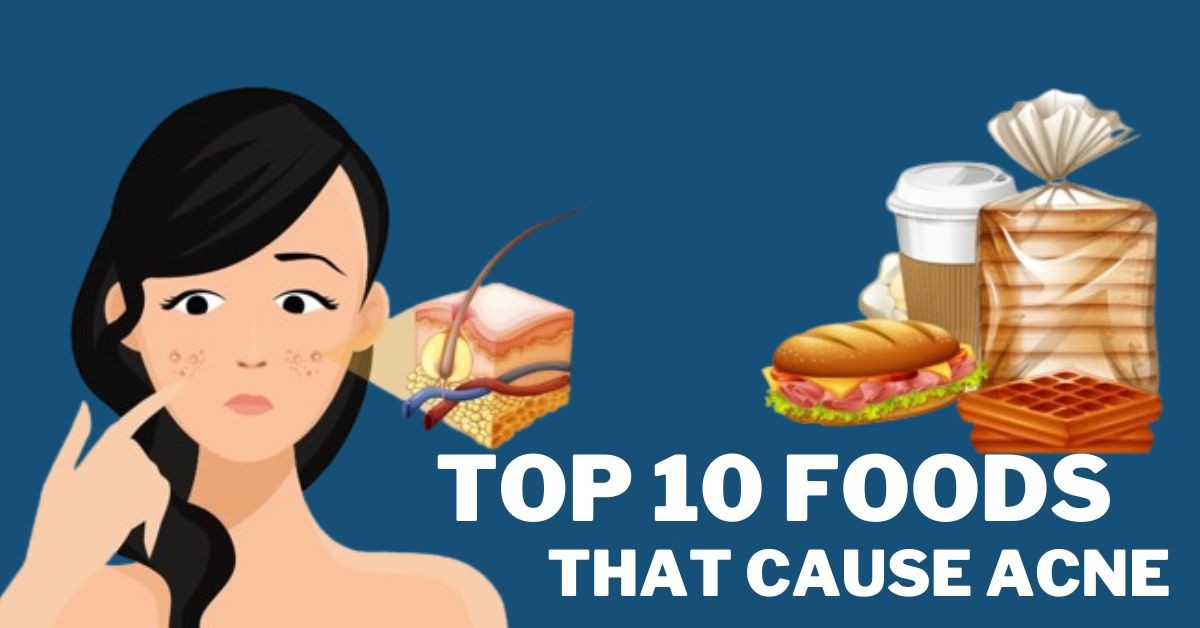 Assortment of foods that may trigger acne outbreaks